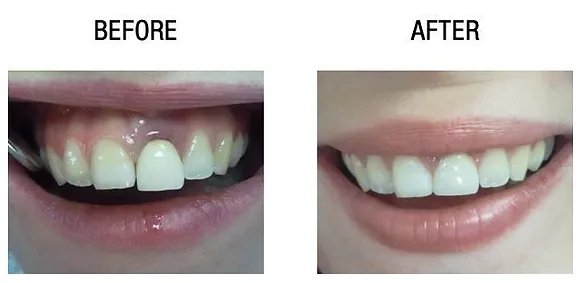 Smile makeover treatment result