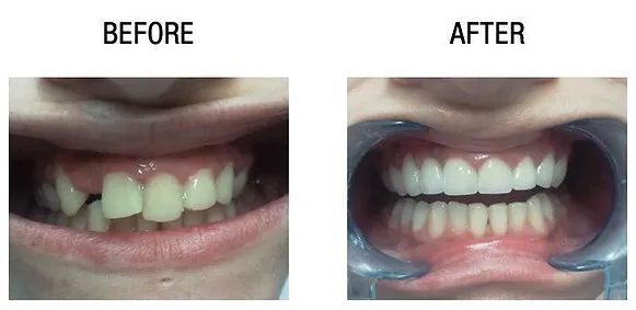 Cosmetic dentistry result in New Gurgaon