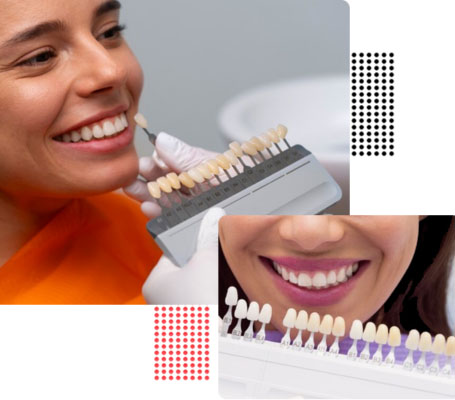 Importance of Veneers - DenTru New Gurgaon
