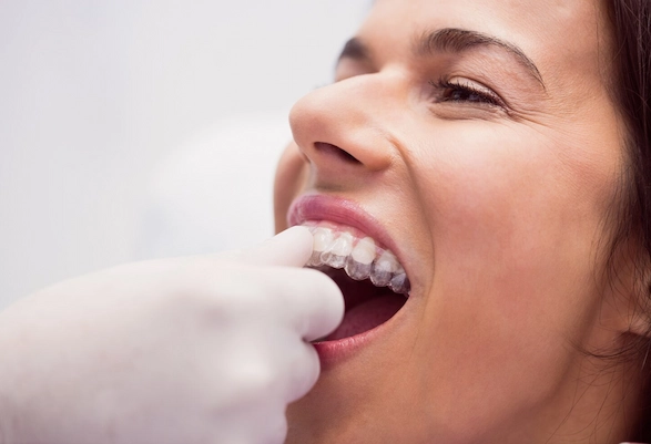 Transparent Teeth Alignment