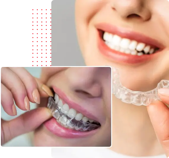 Invisalign Braces Treatment - DenTru New Gurgaon