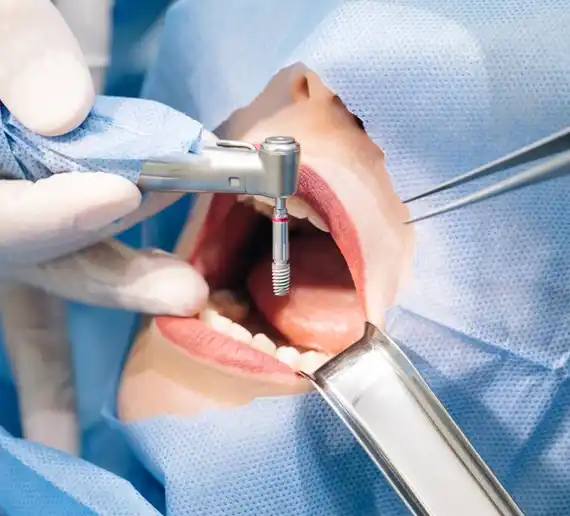 Painless Root Canal Treatment - DenTru New Gurgaon