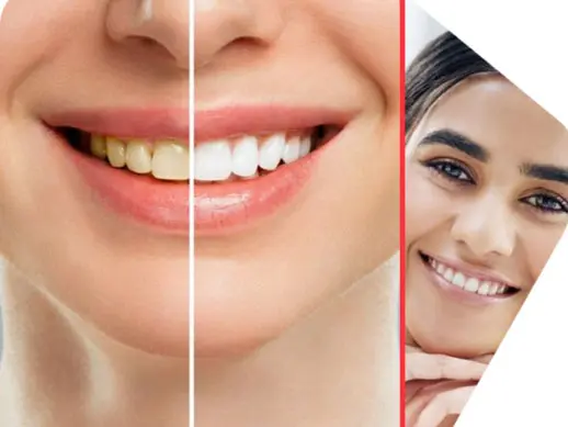 Best Teeth Whitening Treatment - DenTru New Gurgaon