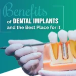 dental-implant-benefits
