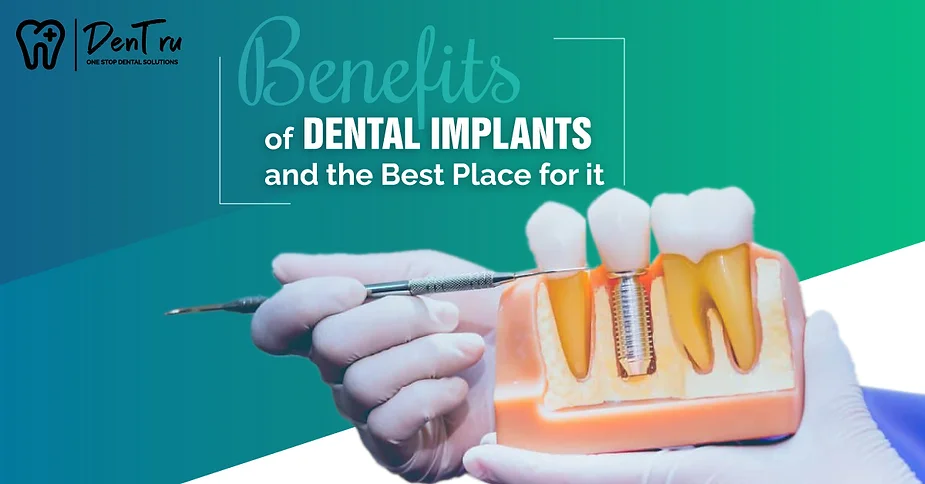 dental-implant-benefits