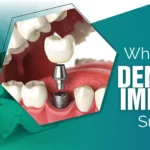 dental-implant-surgery-in-gurgaon