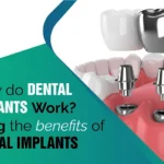 How do dental implants work?