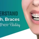 understand-teeth-braces-their-utility