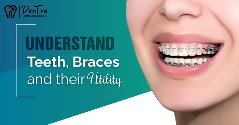 understand-teeth-braces-their-utility