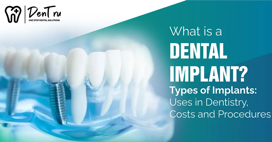 dental-implant-in-gurgaon